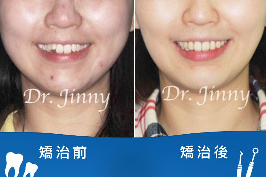 牙齒凌亂（前牙開咬擁擠，下方只有三顆門牙）
