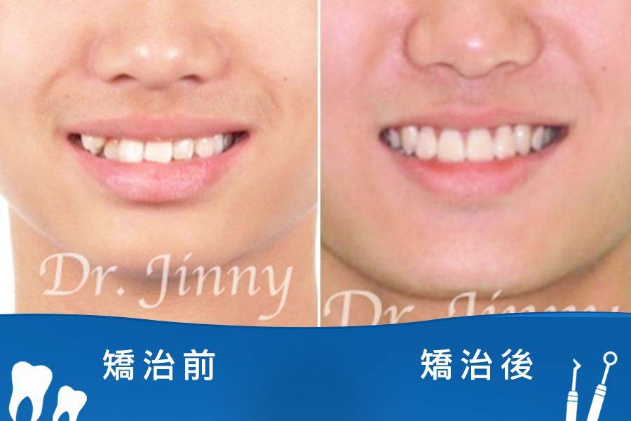牙齒凌亂（單側虎牙）