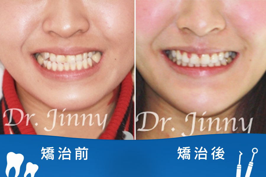 牙齒凌亂（錯咬）