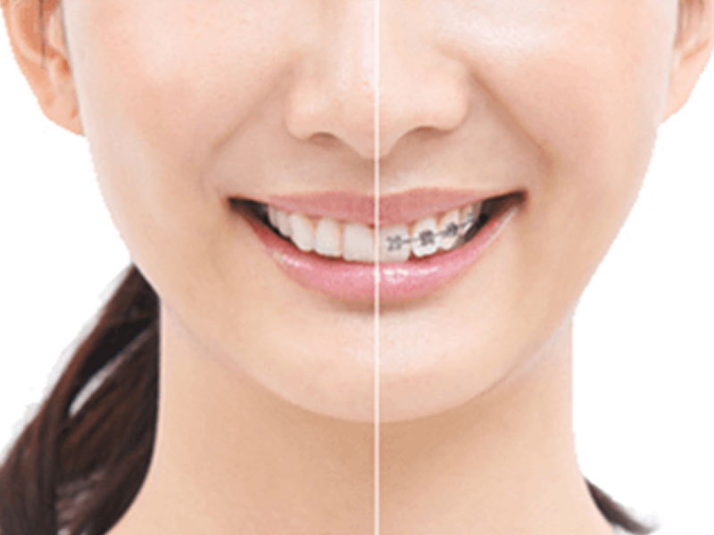為什麼要選擇隱適美隱形矯正呢？