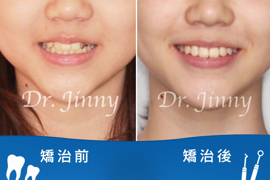 牙齒凌亂（單側虎牙、門牙傾斜）