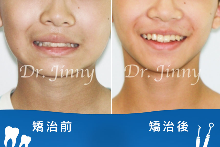 空間不足＆牙齒凌亂（兒童案例）