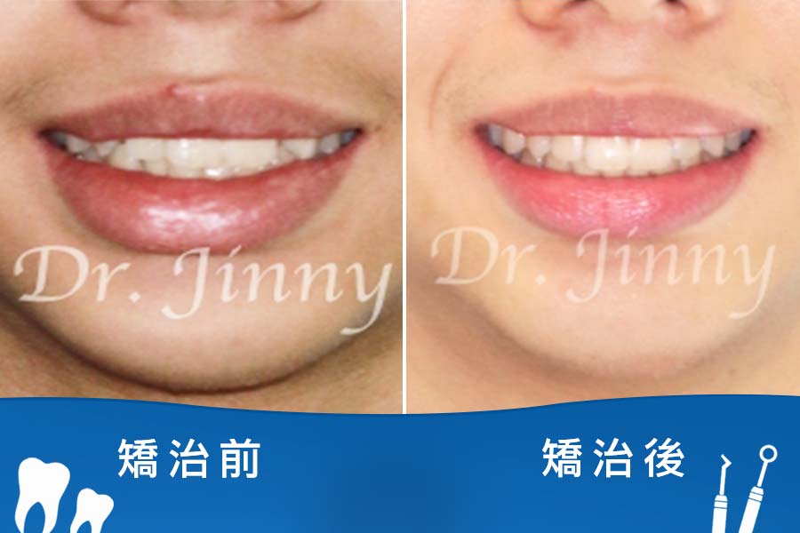 空間不足（不拔牙治療）