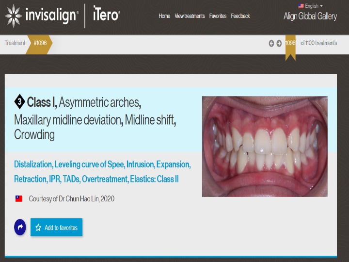 隱適美全球優良案例在這裡－林峻皓醫師