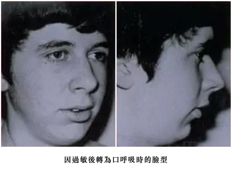 專為兒童打造的兒童隱適美 Invisalign First.