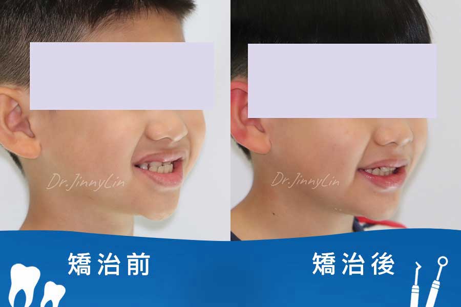 兒童生長誘導 兒童生長誘導